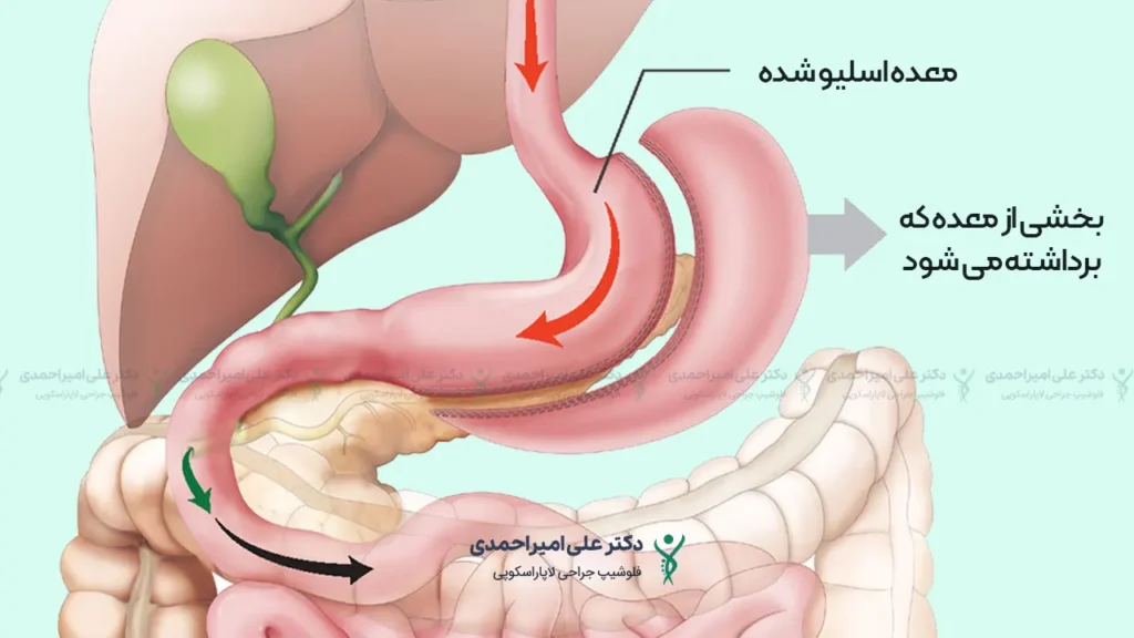 عمل اسلیو معده برای لاغری