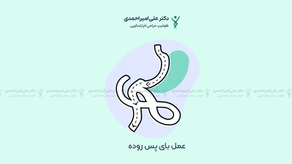 عمل بای پس معده