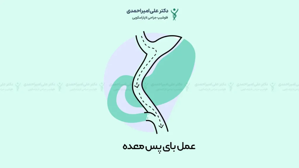 عکس شماتیک عمل بای پس معده