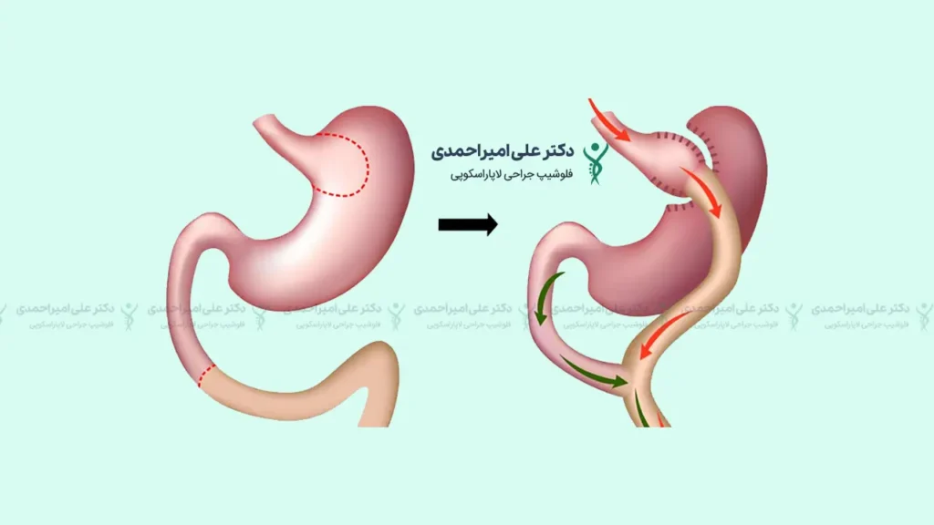 عمل بای پس معده