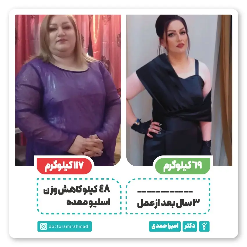 عکس قبل و بعد از عمل اسلیو معده