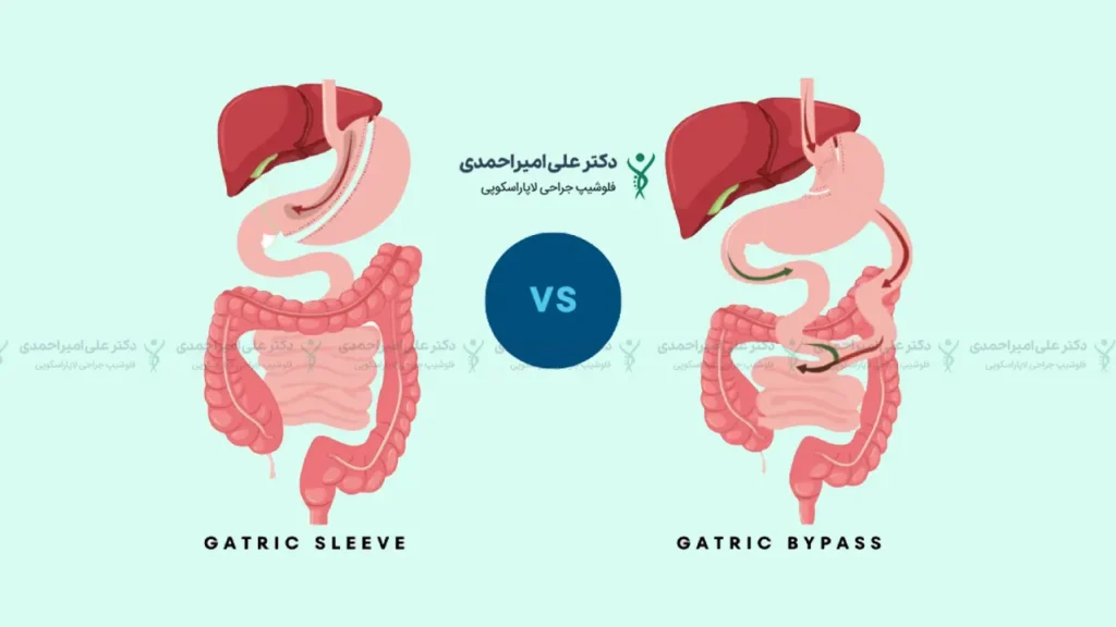 تفاوت اسلیو معده و بای پس