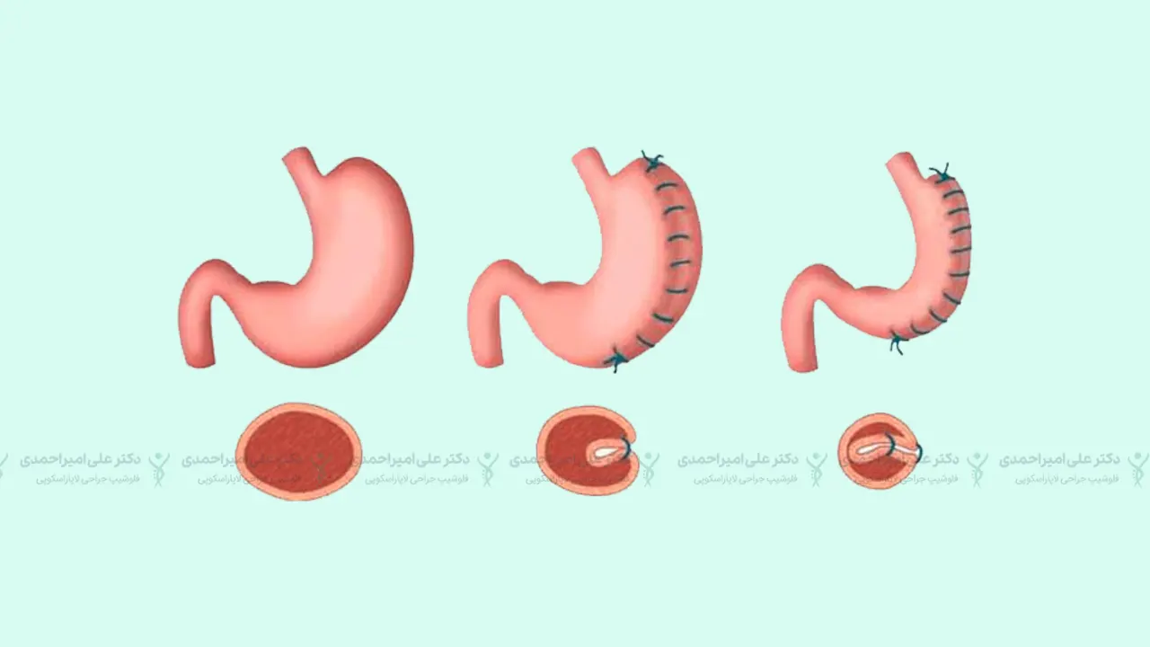 عمل جراحی پلیسه معده