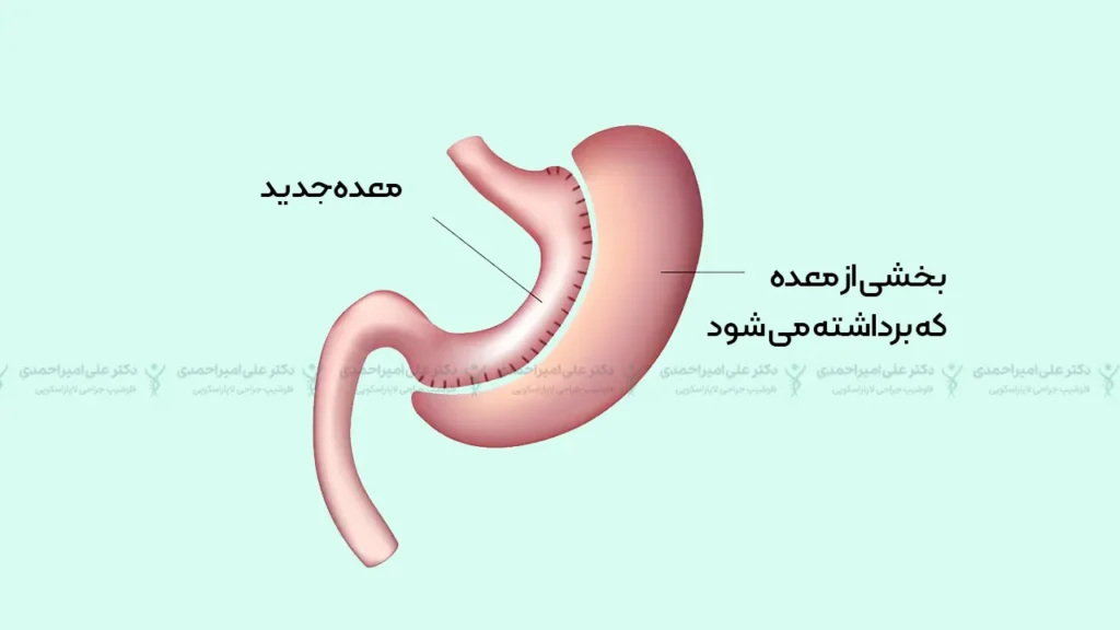 درمان فشار خون با عمل لاغری اسلیو معده