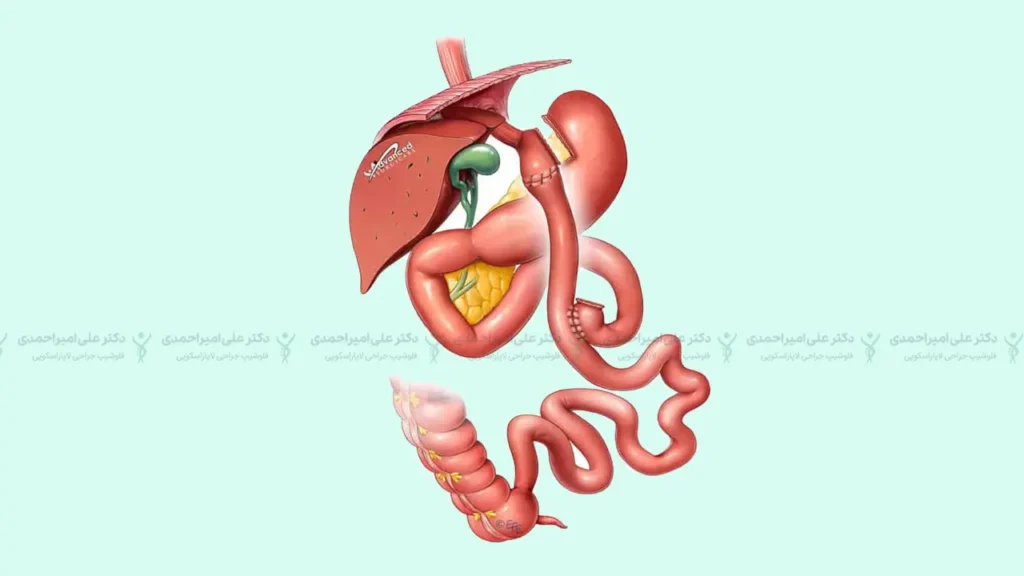 عکس شماتیک عمل بای پس معده