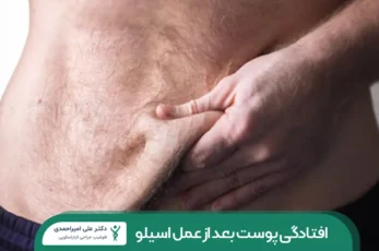 افتادگی پوست بعد از عمل اسلیو معده