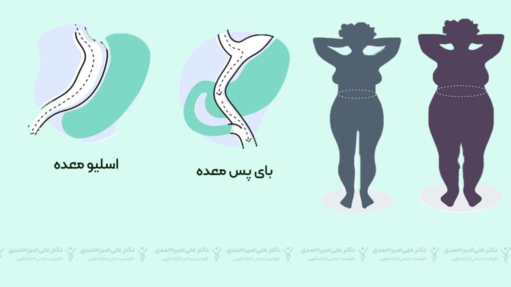 بهترین روش های جراحی لاغری