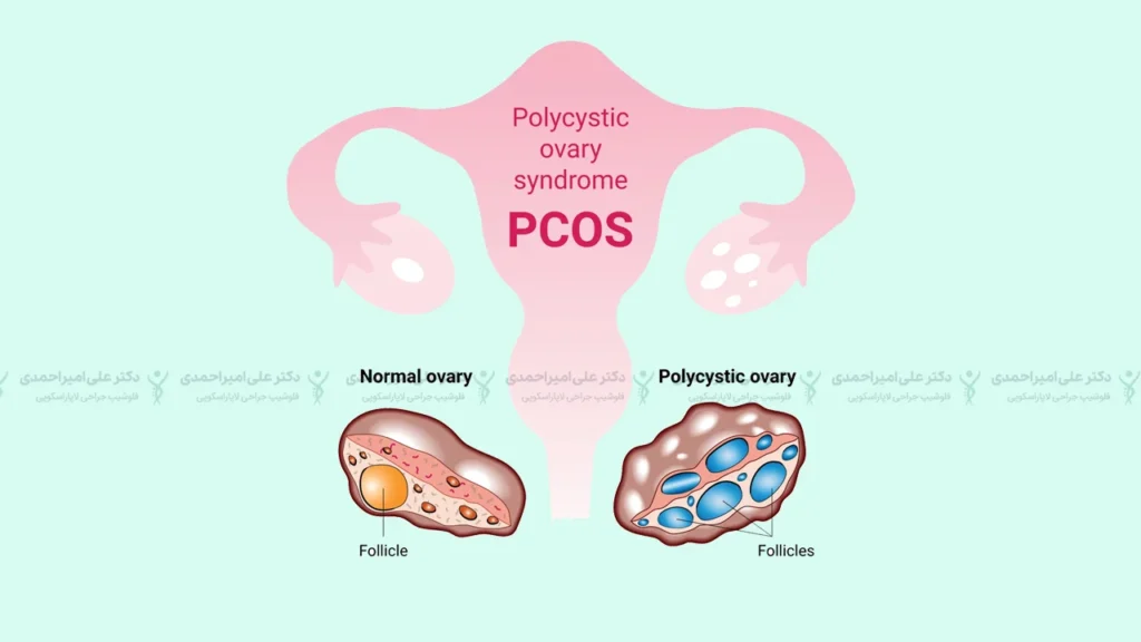 تنبلی تخمدان تصویر شماتیک