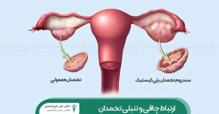 تأثیر چاقی بر تنبلی تخمدان شاخص