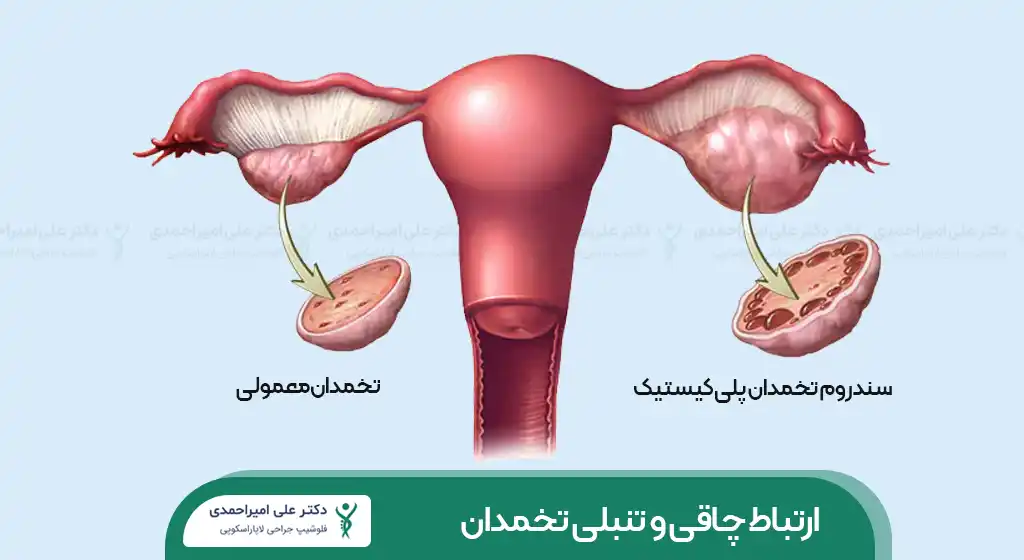 تأثیر چاقی بر تنبلی تخمدان شاخص