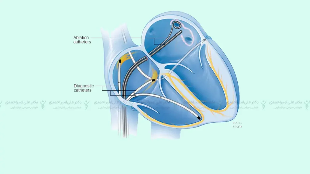 عمل قلب Ablation