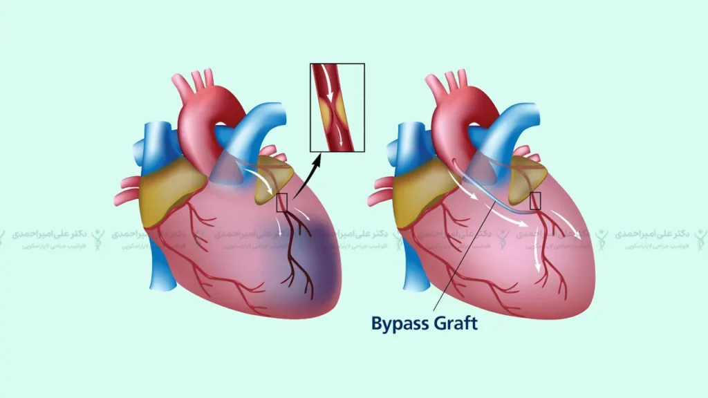 عمل قلب CABG