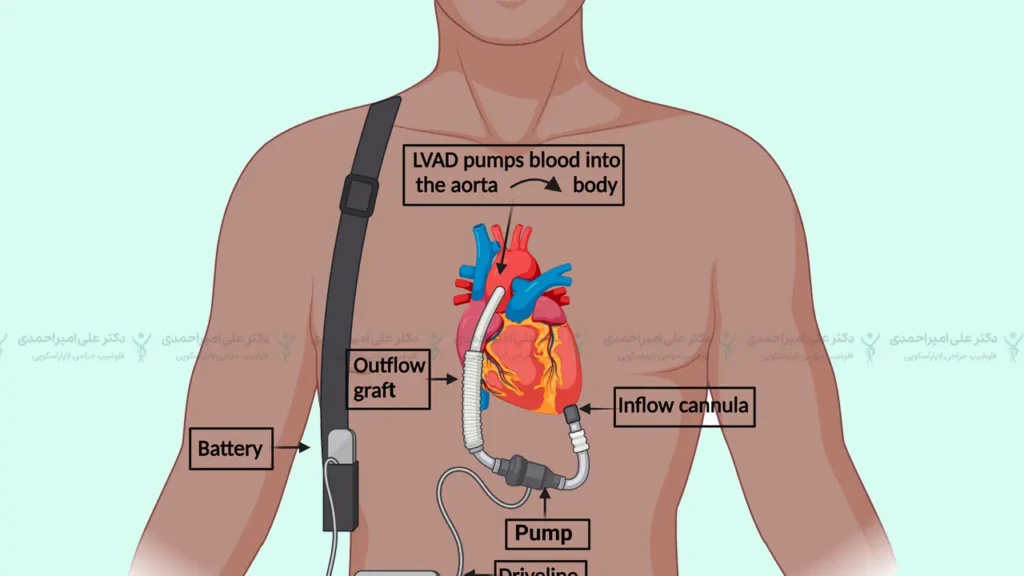 عمل قلب LVAD