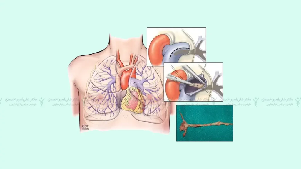 عمل قلب Pulmonary Thromboendarterectomy