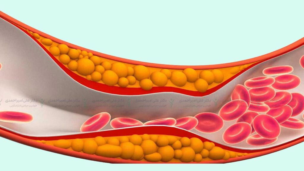 افزایش کلسترول بد خون