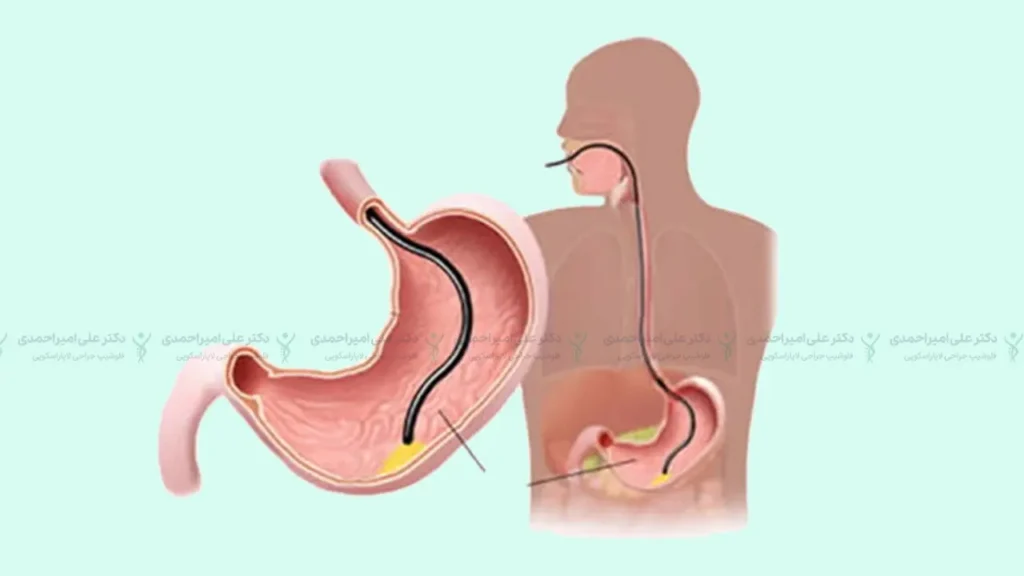 تزریق بوتاکس به معده