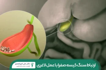 ارتباط سنگ کیسه صفرا با جراحی لاغری شاخص