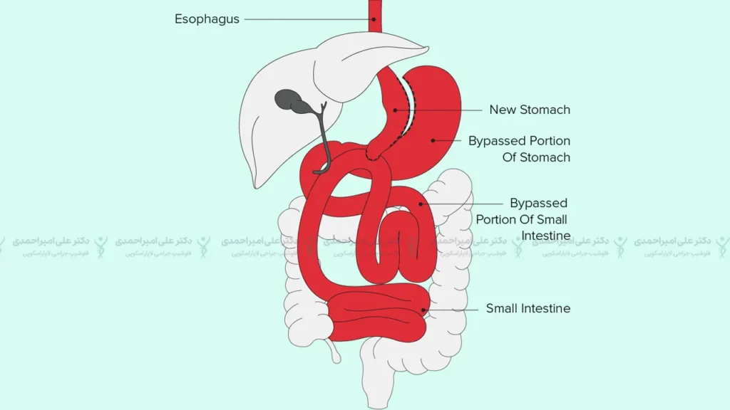 عمل جراحی بای پس معده