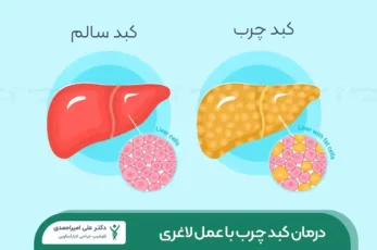 درمان کبد چرب با عمل لاغری شاخص