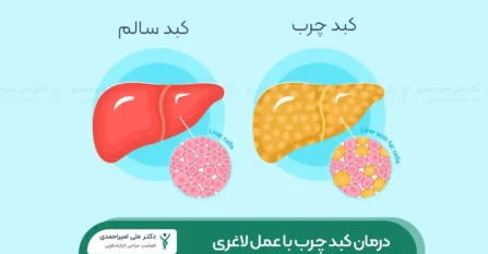 درمان کبد چرب با عمل لاغری شاخص