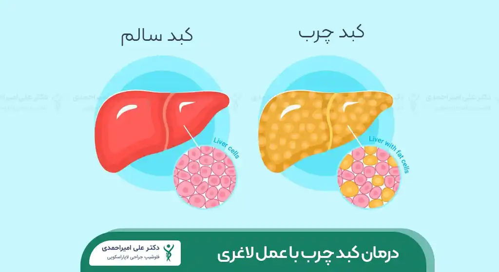 درمان کبد چرب با عمل لاغری شاخص