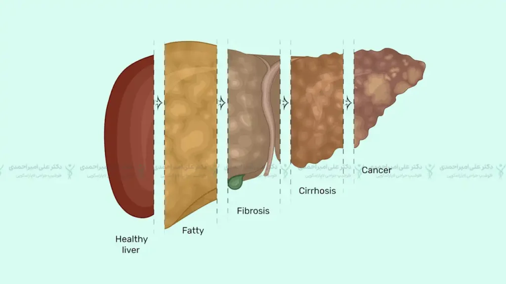مراحل مختلف بیماری کبد از کبد چرب تا سرطان کبد