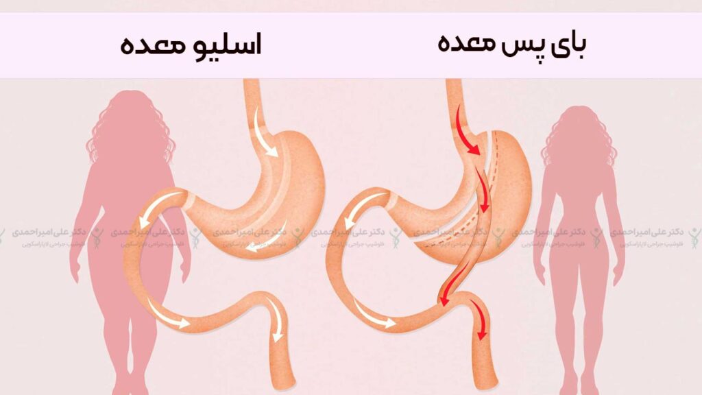 عمل لاغری معده