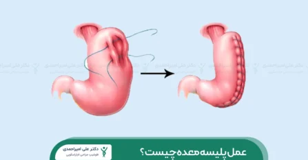 عمل پلیسه معده شاخص