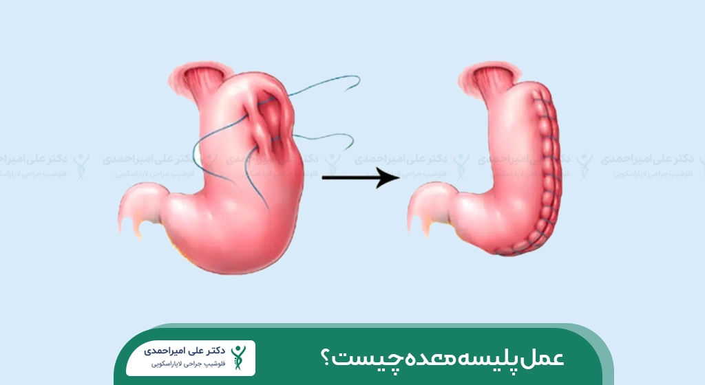 عمل پلیسه معده شاخص