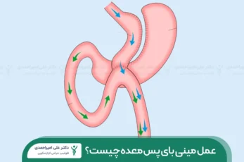 عکس مینی بای پس معده شاخص