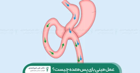 عکس مینی بای پس معده شاخص