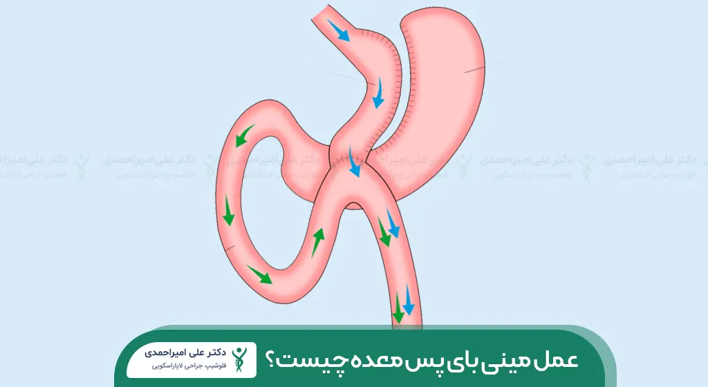 عکس مینی بای پس معده شاخص