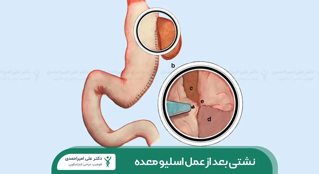 نشتی بعد از عمل اسلیو معده شاخص