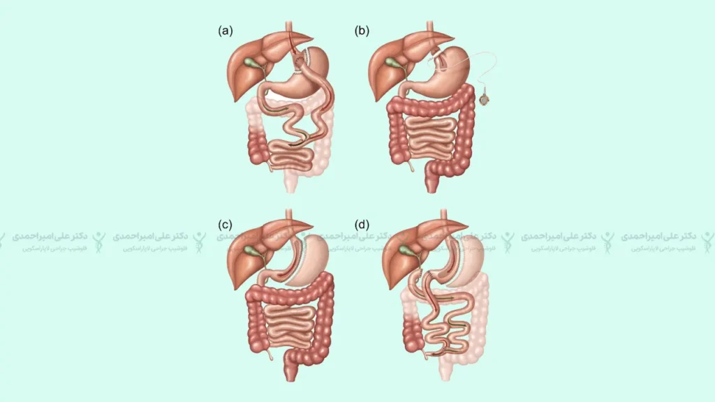 تغییرات اعمال شده روی دستگاه گوارش در عمل جراحی چاقی