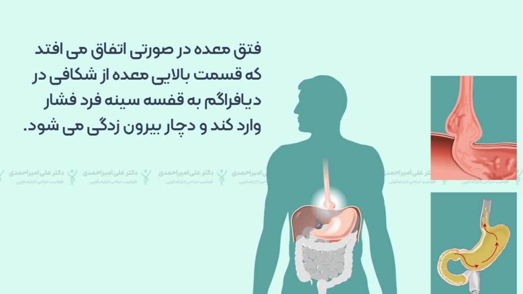 فتق معده یعنی چی؟