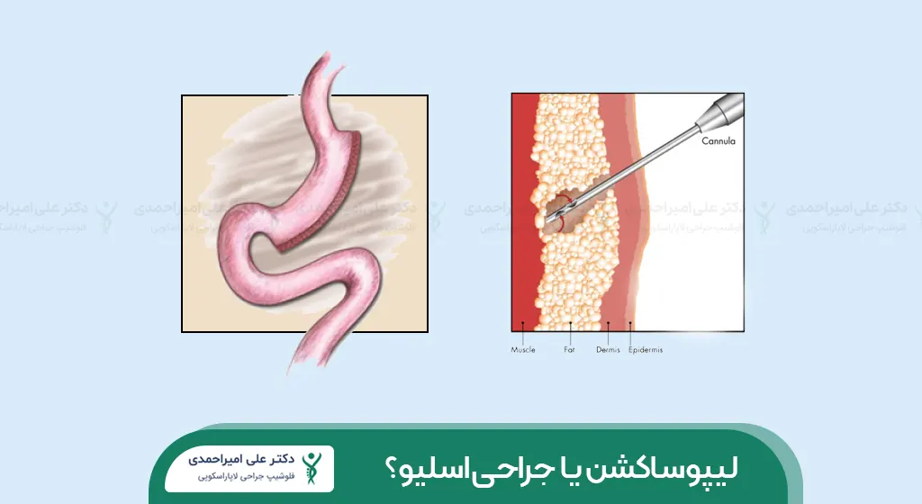 لیپوساکشن یا جراحی اسلیو شاخص