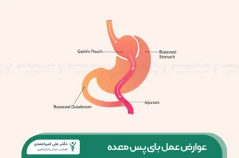 عوارض عمل بای پس معده شاخص