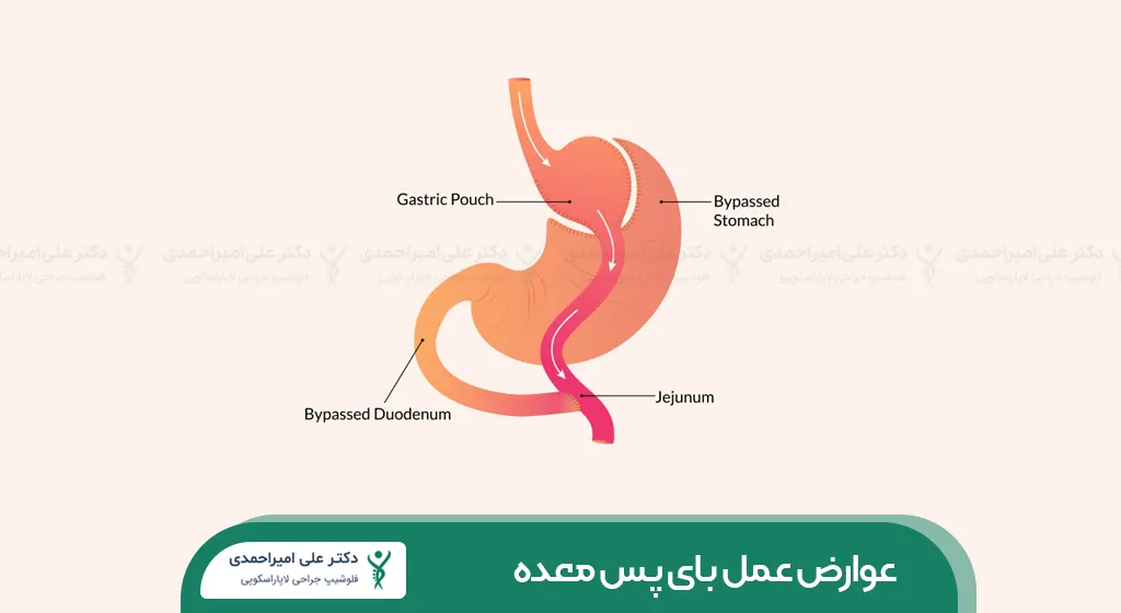 عوارض عمل بای پس معده شاخص