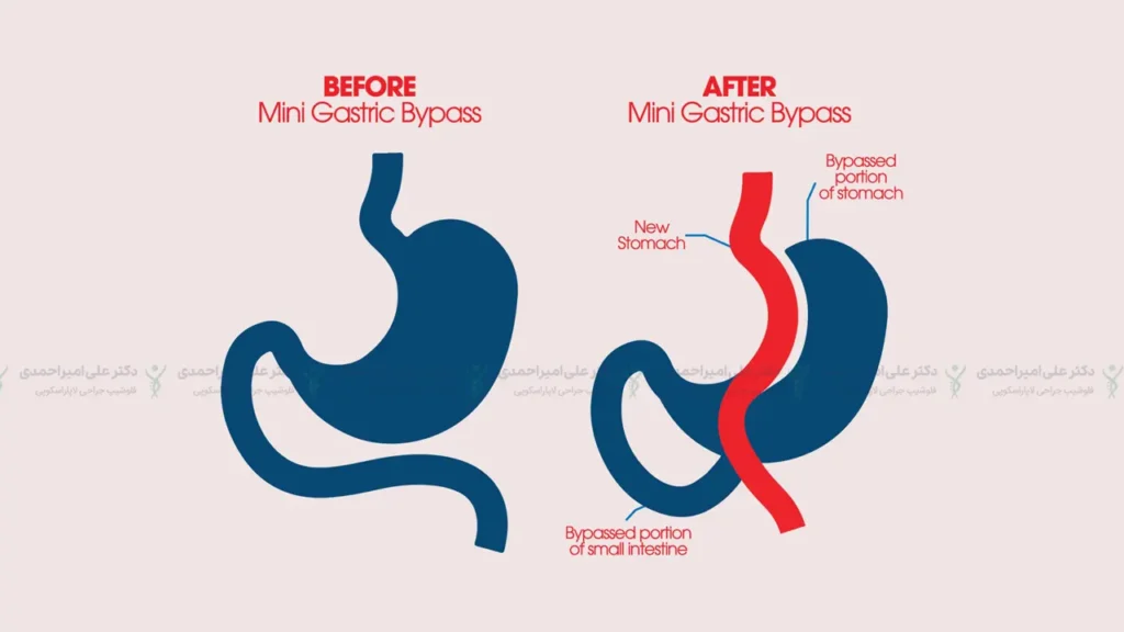 عکس عمل مینی بای پس معده از انواع عمل بای پس معده