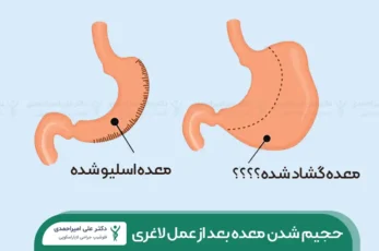 گشاد شدن معده بعد از عمل لاغری شاخص