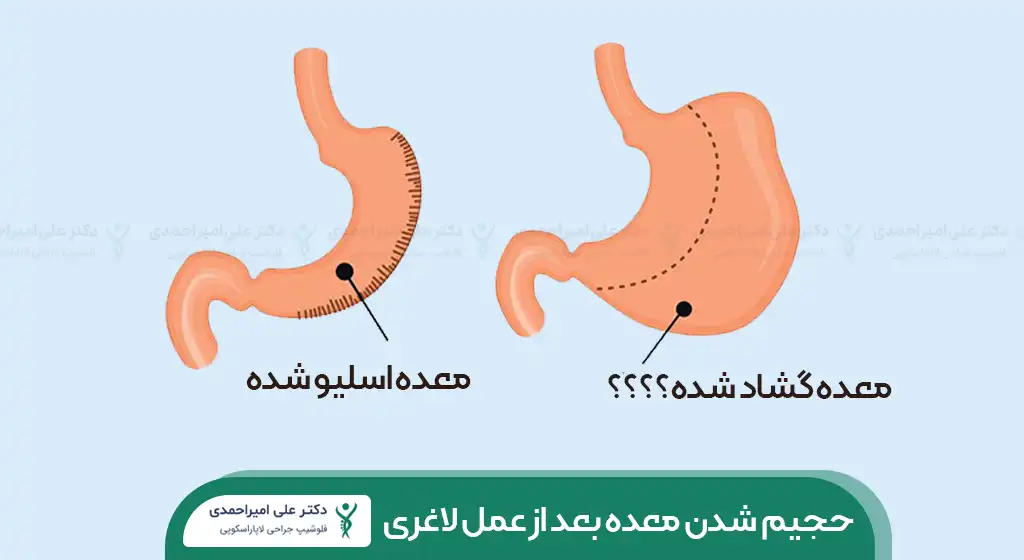 گشاد شدن معده بعد از عمل لاغری شاخص